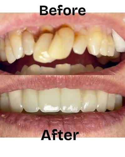 Happy Patient - Dental Implants Uttam Nagar New Delhi